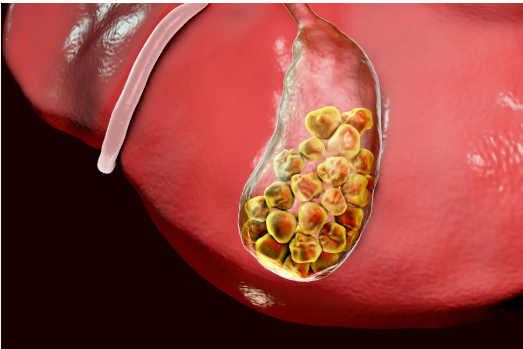 Gallbladder Stones
